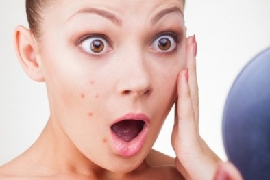 Nám vĩnh viễn vì lột da mặt không đúng cách