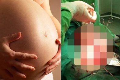 Chết đứng vì thai nhi bỗng biến khối u khổng lồ 