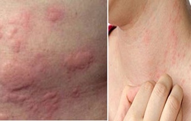 Mẩn ngứa lâu có thể là triệu chứng của ung thư da