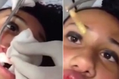 Cô gái mắc chứng bệnh lạ sinh giòi trong miệng