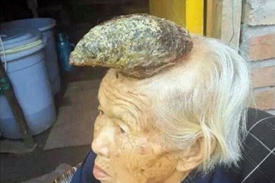 Chuyện lạ có thật: Cụ bà mọc 'sừng kỳ lân' khổng lồ ngay giữa đầu