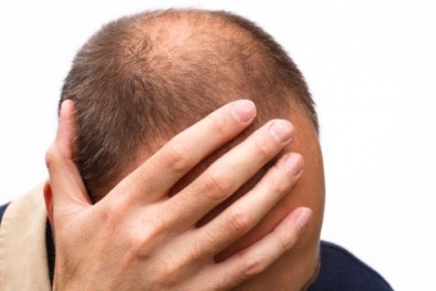  Hói đầu sớm tăng nguy cơ ung thư tuyến tiền liệt