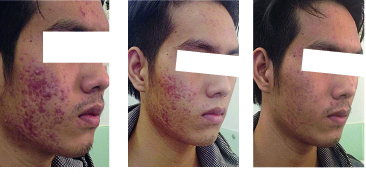 Nhận biết 13Win21 con - Tri ân hội viên mỗi tháng 2000 tỷ chứa corticoid 'làm đẹp thần tốc'