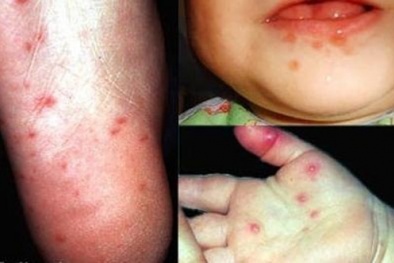 5 trẻ nhỏ tử vong vì bệnh tay chân miệng nguy hiểm