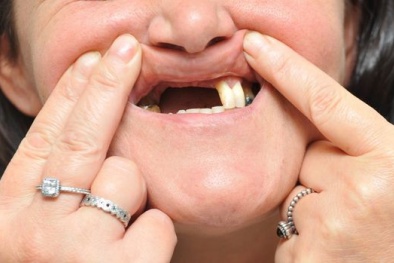 Ru rú trong nhà vì bác sỹ 'lỡ' làm rụng mất đôi răng cửa 