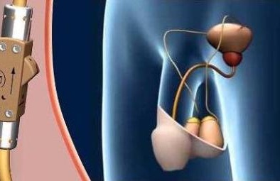Van khóa tinh trùng chỉ bằng một công tắc