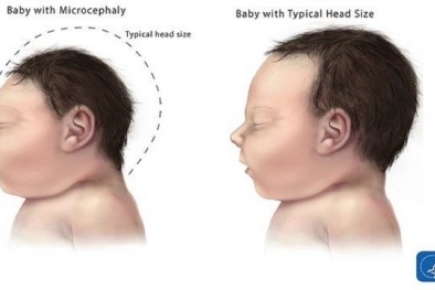Bộ Y tế kêu gọi khẩn toàn quốc phòng chống dịch bệnh do vi rút Zika