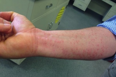 Khánh Hòa: Nguy cơ lây nhiễm virus Zika rất lớn