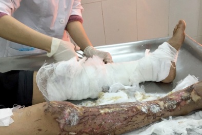 Tiếng thét xé lòng của người phụ nữ hứng trọn chai axit từ bạn tình 65 tuổi