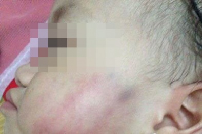 Hà Nội: Làm rõ vụ cô giáo mầm non Ánh Sao tát bé gái 16 tháng thâm tím mặt