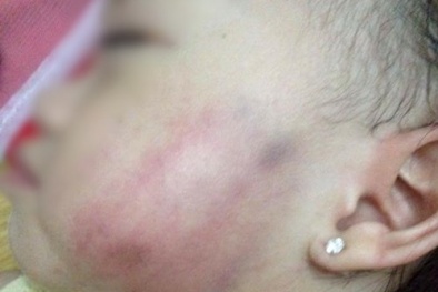 Thông tin mới nhất vụ bé 16 tháng tuổi bị thâm tím mặt ở cơ sở mầm non