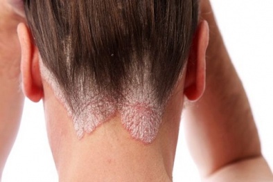 'Phát hoảng' với những vị trí dễ mắc ung thư da đến không ngờ 