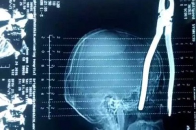 Sống sót kỳ diệu dù bị kìm đâm xuyên đầu 15cm