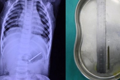 Mẹ ân hận phát hiện đinh trong bụng con vì quá bận