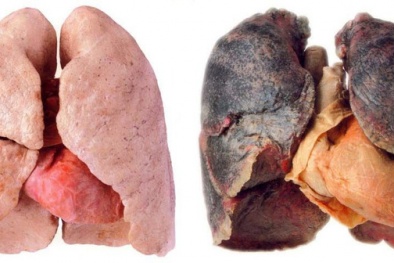 Lời khuyên của bác sĩ bị ung thư  phổi giai đoạn muộn đã di căn 