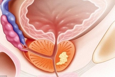 Lời khuyên của bác sĩ giúp nam giới không còn sợ bệnh tuyến tiền liệt 'hỏi thăm'