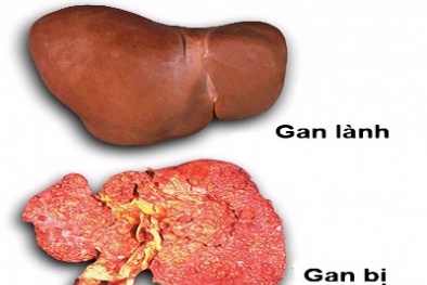 Đau bụng âm ỉ: Dấu hiệu cảnh báo sớm bệnh ung thư