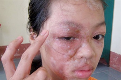 Cách sơ cứu khi bị kiến ba khoang đốt và sử dụng thuốc điều trị