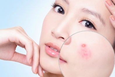 Những thói quen hàng ngày khiến da mụn trở nên tồi tệ hơn 