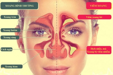Mùa lạnh, dùng thuốc nào điều trị bệnh viêm xoang?
