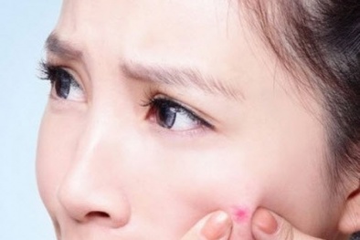 Vị trí mụn mọc trên mặt nói gì về tình trạng 13Win19 ưu đãi hấp dẫn?
