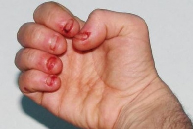 Tử vong vì một thói quen tưởng vô hại nhưng nhiều người mắc phải