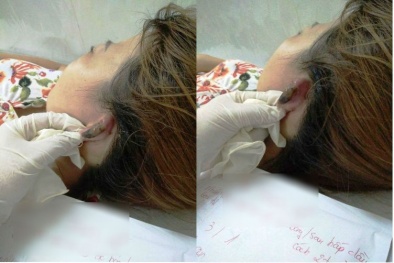 Hoại tử tai, bỏng cả mảng da đầu vì hấp tóc đón Tết 