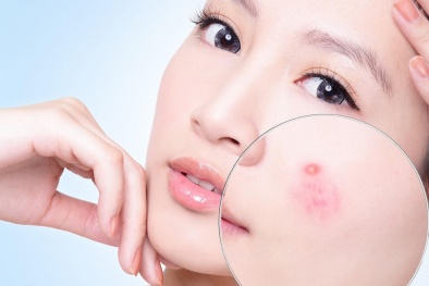 Bỏng loét thực quản vì uống thuốc trị mụn 