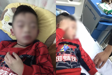 Trẻ sưng vù mặt vì nghi uống trà sữa, cha mẹ hết sức thận trọng