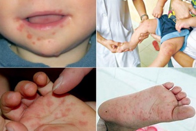 Bộ Y tế cảnh báo bệnh tay chân miệng có khả năng thành dịch lớn