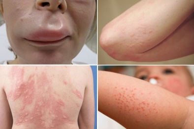 Những sai lầm khi sử dụng thuốc điều trị dị ứng thời tiết