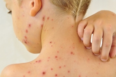 Tin cảnh báo: Bệnh thủy đậu bùng phát ‘chóng mặt’ nhiều nơi