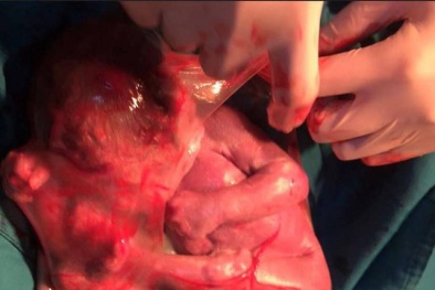 Hy hữu: Bé gái chào đời vẫn còn nguyên túi ối ở Nghệ An