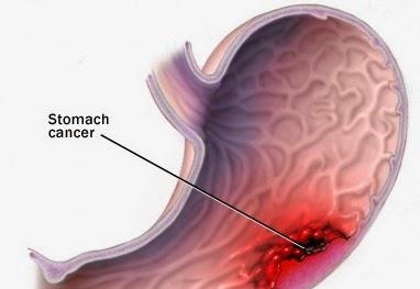 Cách phòng trị bệnh ung thư dạ dày ở người lớn