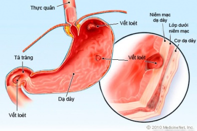 'Thực phẩm vàng' chữa viêm loét dạ dày đơn giản ít ai ngờ