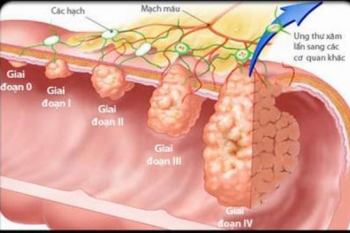 Ung thư dạ dày phát triển thần tốc bởi thói quen khiến nhiều người 'ngã ngửa'