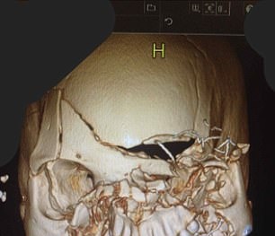 Hình ảnh chụp sọ này sẽ làm bạn  nhất định phải cài dây an toàn khi đi xe