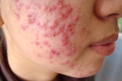 Sức tàn phá kinh hoàng cho làn da khi sử dụng 13Win21 con - Tri ân hội viên mỗi tháng 2000 tỷ chứa corticoid