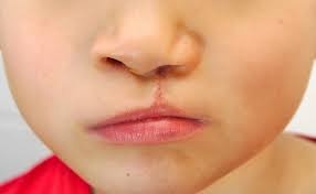 Ngày nhân đạo DrD hỗ trợ chi phí phẫu thuật sửa sẹo mũi môi dị tật cho trẻ