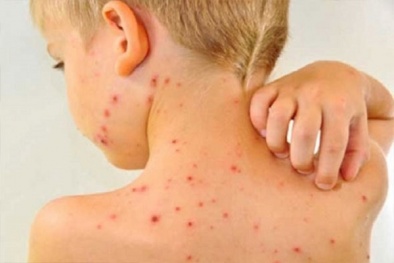Cẩn trọng kẻo mắc bệnh da liễu do thời tiết nồm ẩm