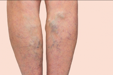 Cảnh báo: Suy tĩnh mạch là dấu hiệu của huyết khối