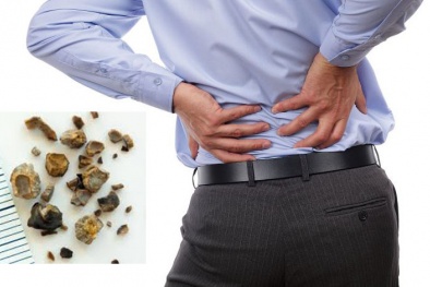 Nguy cơ sỏi thận vì 3 thói quen hầu như ai cũng mắc phải