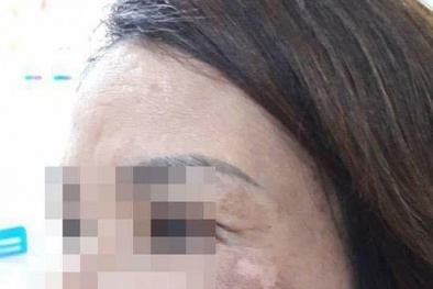 Dùng cao trầu không trị nám, một phụ nữ bị tổn thương da mặt nghiêm trọng