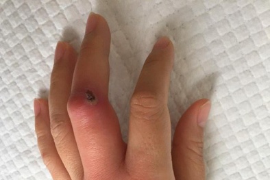 Vết xước nhỏ cũng có thể giết chết bạn, giống như người phụ nữ này!