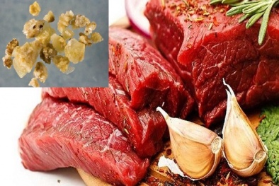 Thực phẩm hàng đầu gây sỏi thận cần tránh dùng thường xuyên