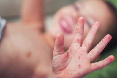 Bệnh chân tay miệng lây lan chóng mặt: Các dấu hiệu nhận biết sớm nhất