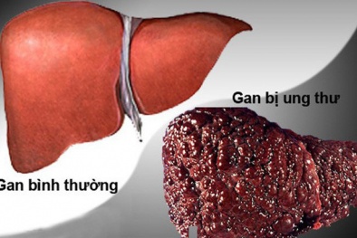 Ung thư gan: 4 dấu hiệu nguy hiểm ‘chết người’ nhiều người thường bỏ qua