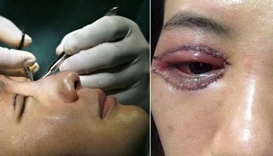 Làm đẹp đôi mắt đón Tết, coi chừng biến chứng khó lành