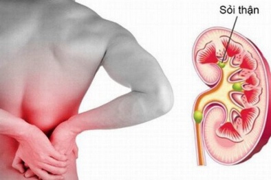 Bệnh sỏi thận - Điều trị sai có thể gây vỡ thận, tử vong cao