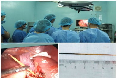Ngậm tăm khi ngủ - những 'tai nạn' hy hữu đã đe dọa tính mạng nhiều người